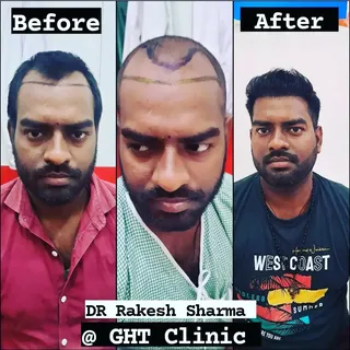 Get your Hair transplant done and get your old look back #best results #fue #hairtransformation #hai