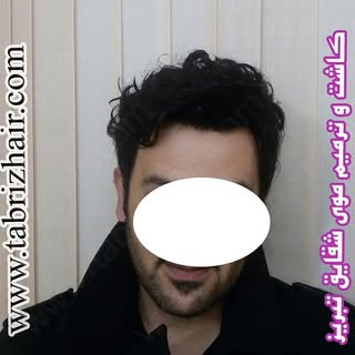 کاشت  و  ترمیم  موی  شقایق 
شماره  تماس  09144015283 
شماره  تلگرام  09904498848 
کاشت  و ترمیم  موی