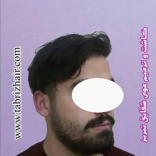 کاشت  و  ترمیم  موی  شقایق  در  تبریز