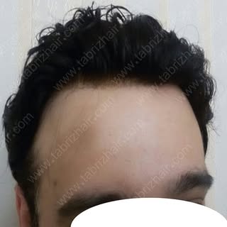 کاشت  و  ترمیم  موی  شقایق  در  تبریز 
شماره  تماس  09144015283 
شماره  تلگرام  09904498848
