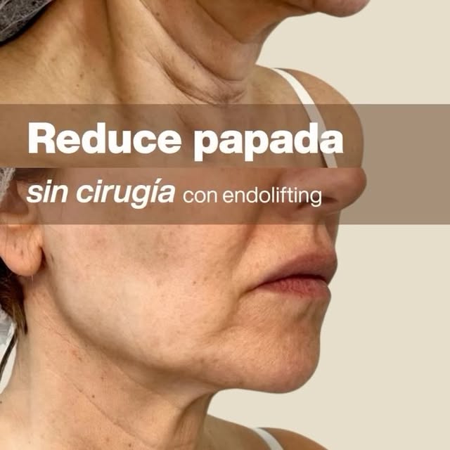 ✅ Reducir papada sin cirugía es posible. 

En este reel, el Dr. Avelino Rey te cuenta qué zonas se p