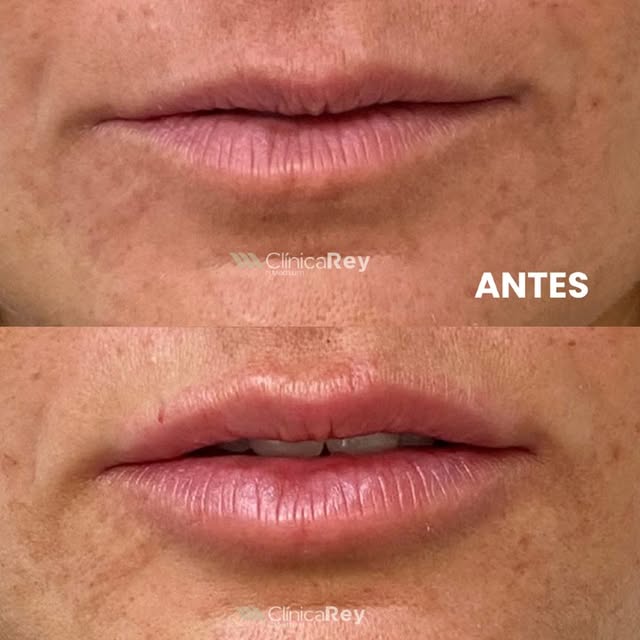 ¿Labios más bonitos sin perder naturalidad?

El relleno de labios no consiste únicamente en aportar 