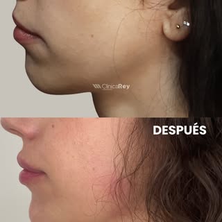 La armonía facial no siempre requiere grandes cambios.

En este caso, el objetivo fue equilibrar el 