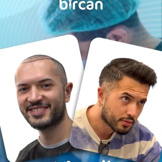 After 1 year 
Operation method : FUE
Graft number : 3100
Donor zone quality: 100% 
Transplanted area