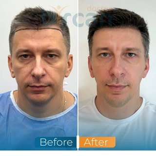 6-month transformation of a 3500-graft hair transplant procedure, designed in alignment with natural