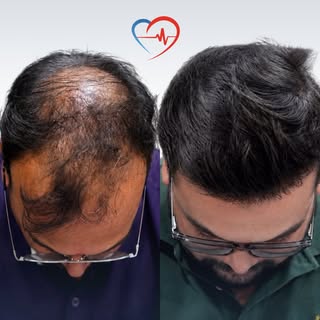 That perfect transformation you’ve been dreaming of😀

• 4500 Grafts transplanted
• Technique: FUE
•