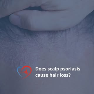 Noticed your hair thinning because of scalp psoriasis? Don’t panic! ✋🏻

The itching, flaking, and p
