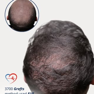 One FUE session, one transformative experience, and a permanent result that lasts a lifetime.

• 370