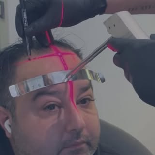 Give your hair a chance to glow!

• 3600 Grafts transplanted
• Technique: FUE
• Result: 12 Months 

