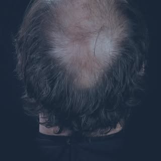 Give your hair a chance to glow!

• 4000 Grafts transplanted
• Technique: FUE
• Result: 9 Months 

F