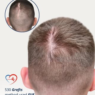 A scar on your scalp doesn’t have to define you. Modern hair transplantation can effectively conceal