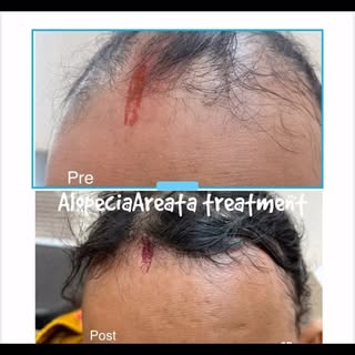 ☑️Alopecia areata is autoimmune damage of hair follicles leading to variable patches of alopecia or 