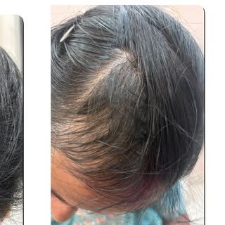 ✨ Real Results. Real Confidence. ✨

Alopecia Areata can cause sudden hair loss, but with the right d
