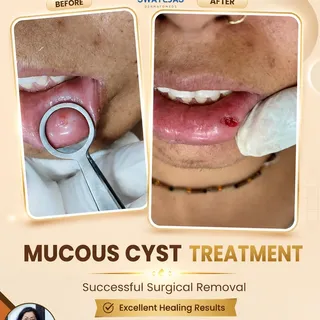 ✨ म्यूकस सिस्ट (Mucous) का सफल उपचार ✨

क्या आपके होंठ के अंदर बार-बार सूजन या पानी से भरी गांठ बन ज