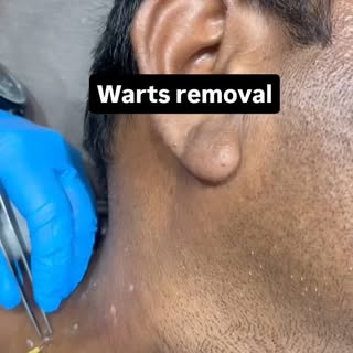 #wartsremoval