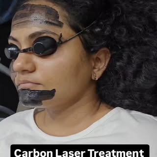 #carbonlaserfacial