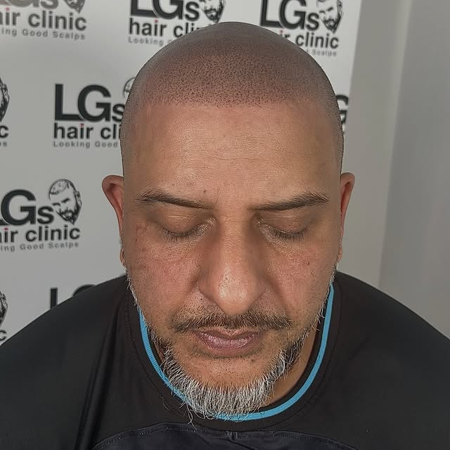 Frame your face with a hairline 👌🏽

This is Scalp Micropigmentation Treatment 
✔️ Quick 
✔️ Pain f