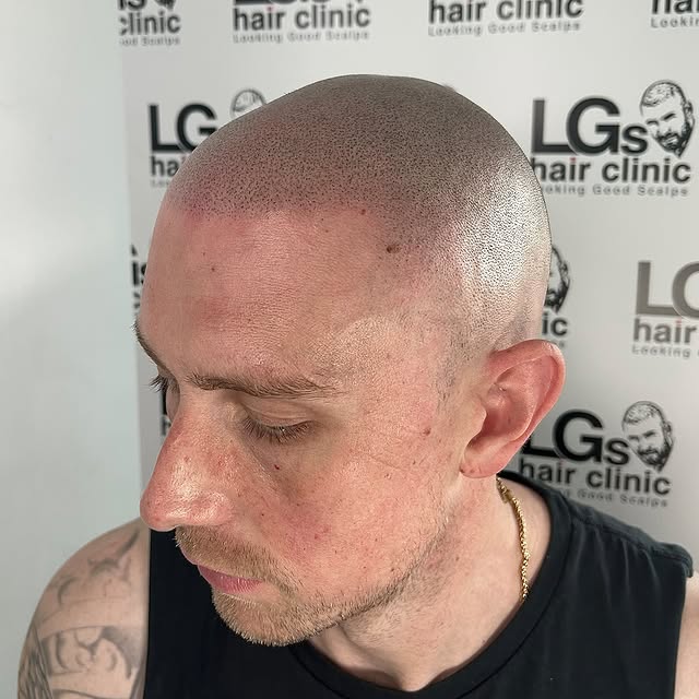 Hairlines back, summers here… life is good 😅 

Interested in the treatment? Send photos of your hai