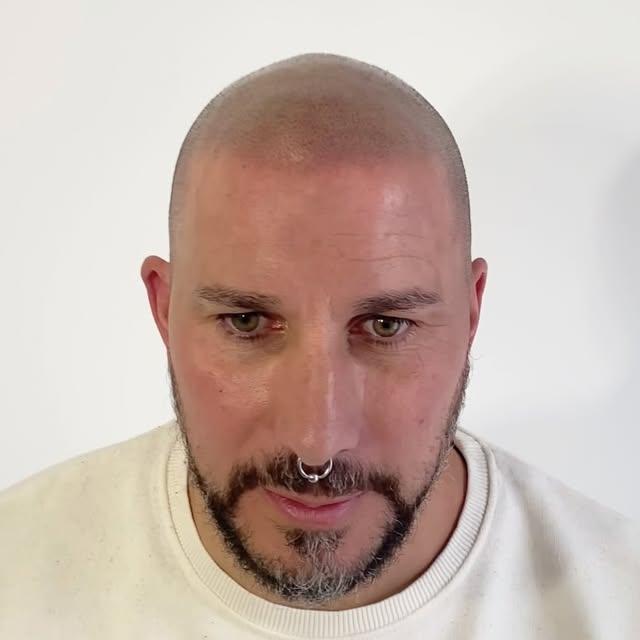 THIS IS A HAIR TATTOO (scalp Micropigmentation) 

Having hairline frames your face and makes you loo