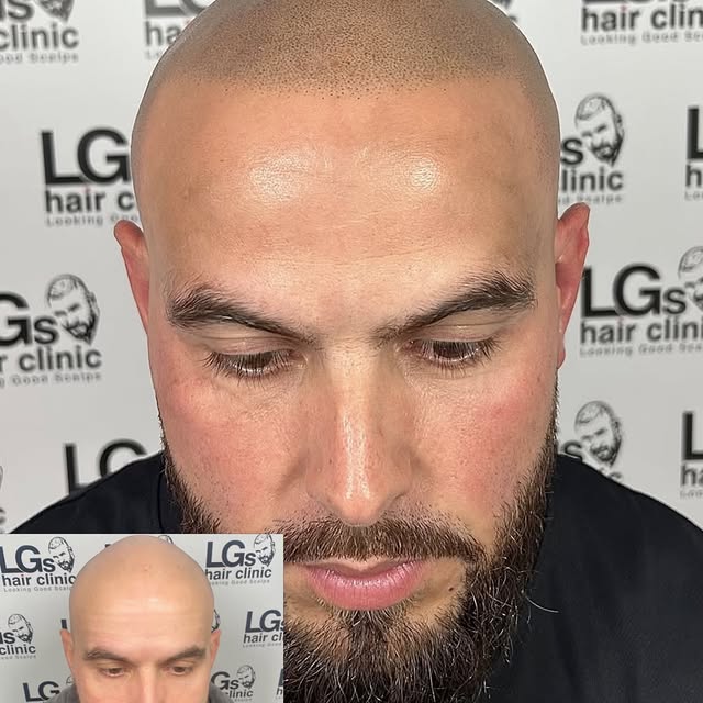 ✨ Confidence, restored ✨

From thinning hair to a clean, fuller-looking hairline with Scalp Micropig