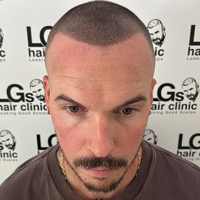Thinning hair? No problem 🤝🏼 we added more density to this clients hairline and crown area, creati