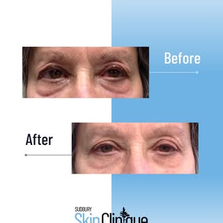 One treatment. One noticeable difference. ✨

These before & after results showcase the power of Plex