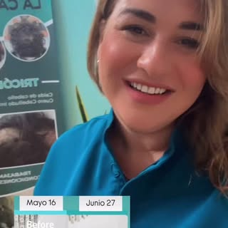 ¿Notas caída de cabello, caspa, adelgazamiento capilar o alguna condición en tu cuero cabelludo?

Mi