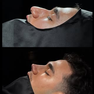 Precision that speaks for itself.

Sculpted. Sharpened. Seamless.🖤 

#newnosenewme #nosejob #nosejo