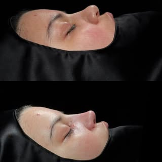This beautiful patient came in for a rhinoplasty, and even in the early healing phase, the results a