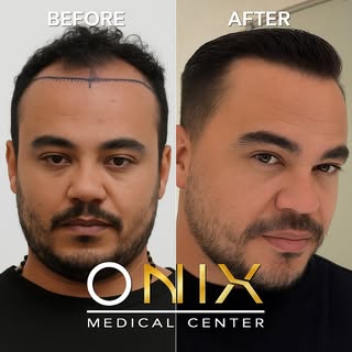 💇‍♂️ ¿Quieres recuperar tu cabello y tu confianza?
En Onix Medical Center hacemos posible tu transf