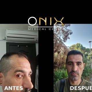 ✨ Resultados que hablan por sí solos ✨

Nuestro paciente decidió confiar en ONIX Medical Center y ho