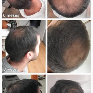 ✨ Evolución real. Resultados visibles. ✨

Este paciente comenzó su tratamiento de Revitalización Cap