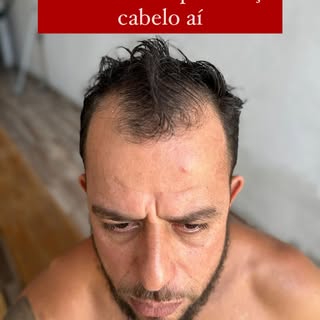 Já se passaram 1 ano e 6 meses desde
 o meu Transplante Capilar! 

Isso com certeza foi a melhor esc