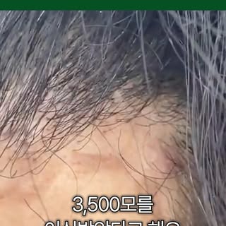 터키에서 모발이식을 하고 왔다..?!
해외모발이식 괜찮을까..?🤔
#모발이식 #탈모치료 #강남모발이식 #남성탈모 #탈모