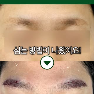 이식한 눈썹이 뻗치는 진짜 이유는..?!
#모발이식 #탈모치료 #눈썹이식 #남성탈모
