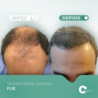 Quer recuperar o seu cabelo com resultados naturais
e duradouros? Faça como este nosso paciente 🤩 e