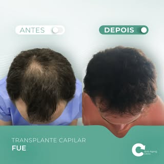 Antes: Cabelo fraco, entradas pronunciadas e baixa autoconfiança.
Depois: Cabelo denso, aparência re
