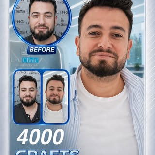 A successful result in hair transplantation depends not only on the day of the operation; It is shap
