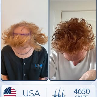 Blonde-reddish hair transplants can achieve outstanding results when performed by an experienced tea