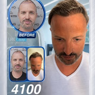 Ever wondered how newly implanted hair grafts grow month by month? 

Watch the incredible transforma