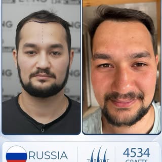 Considering a Hair Transplant in Turkey?

Turkey has become one of the world’s leading destinations 