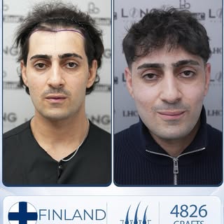 From feeling insecure about your appearance to looking confident, youthful, and handsome, a hair tra