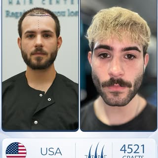 Your baldness can be restored with just 4,000–4,500 grafts.

Hair loss is no longer something you si