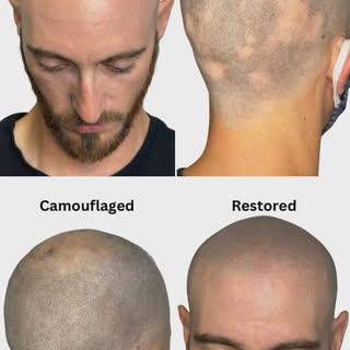 Hair loss holding you back? 🖤

Transform your look with scalp micropigmentation and boost your conf