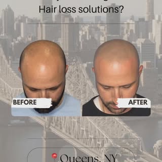 Welcome to New Life Scalp in Long Island City, Queens! ✨ Specializing in scalp micropigmentation and