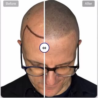 🔥 Say goodbye to bald spots and hello to confidence! 🔥
This amazing hairline tattoo transformation