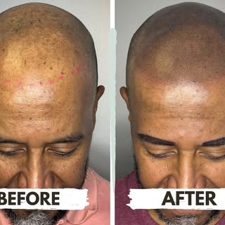 🔥 Transform Your Look with Scalp Micropigmentation! 🔥
Check out this amazing before-and-after! Wit