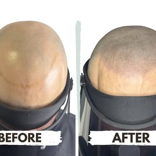 Not a filter. Not a hair transplant. Just real results. 👌

Swipe to see the difference.

Scalp Micr