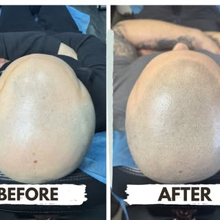 Not a hair transplant. Not a temporary fix. Just real, natural-looking results. 👌

Scalp Micropigme