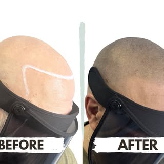 No surgery. No hiding under a hat. No endless products that overpromise and underdeliver.

Just a cl